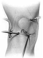 画像：膝の内視鏡手術