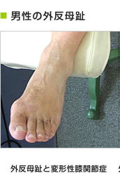男性の外反母趾 外反母趾と変形性膝関節症