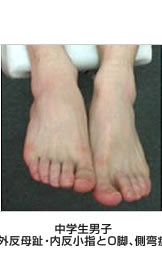 男性の外反母趾外反母趾 中学生男子/外反母趾・内反小指とO脚、側弯症
