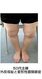 外反母趾と損傷との関係 50代主婦/外反母趾と変形性膝関節症