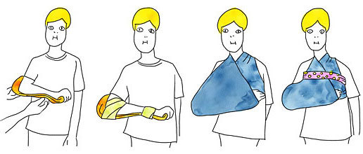前腕・手首の固定方法