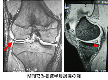 MRIでみる膝半月損傷の例